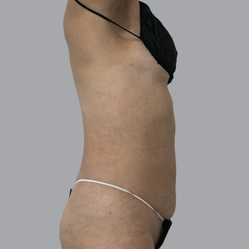 Body Liposuction Before & After Gallery - Patient 988427 - Image 4
