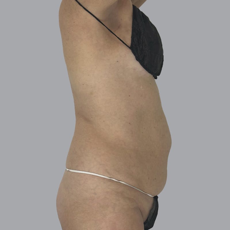 Body Liposuction Before & After Gallery - Patient 988427 - Image 3