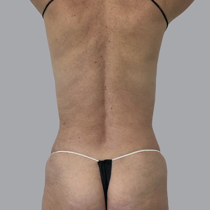 Body Liposuction Before & After Gallery - Patient 988427 - Image 6
