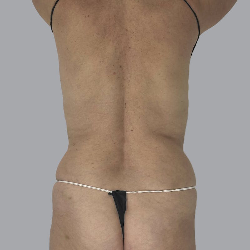 Body Liposuction Before & After Gallery - Patient 988427 - Image 5