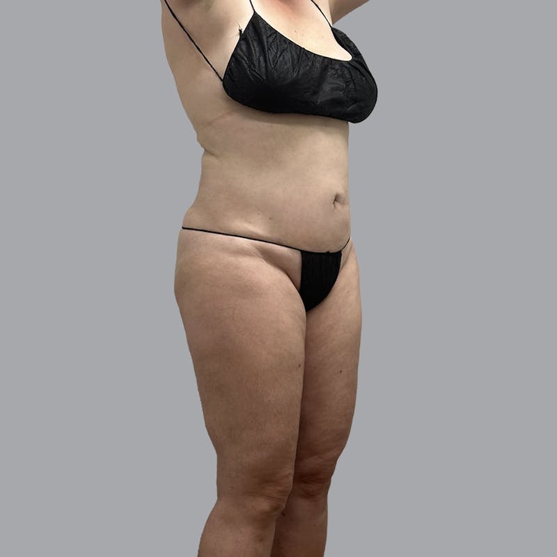 Body Liposuction Before & After Gallery - Patient 400657 - Image 4