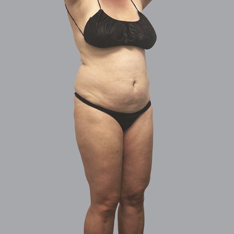 Body Liposuction Before & After Gallery - Patient 400657 - Image 3
