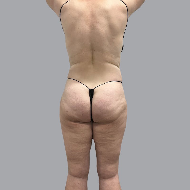 Body Liposuction Before & After Gallery - Patient 400657 - Image 6