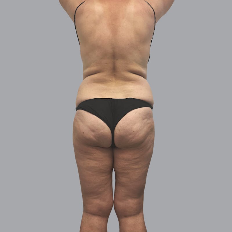 Body Liposuction Before & After Gallery - Patient 400657 - Image 5