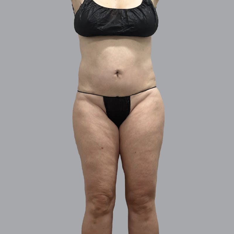 Body Liposuction Before & After Gallery - Patient 400657 - Image 2
