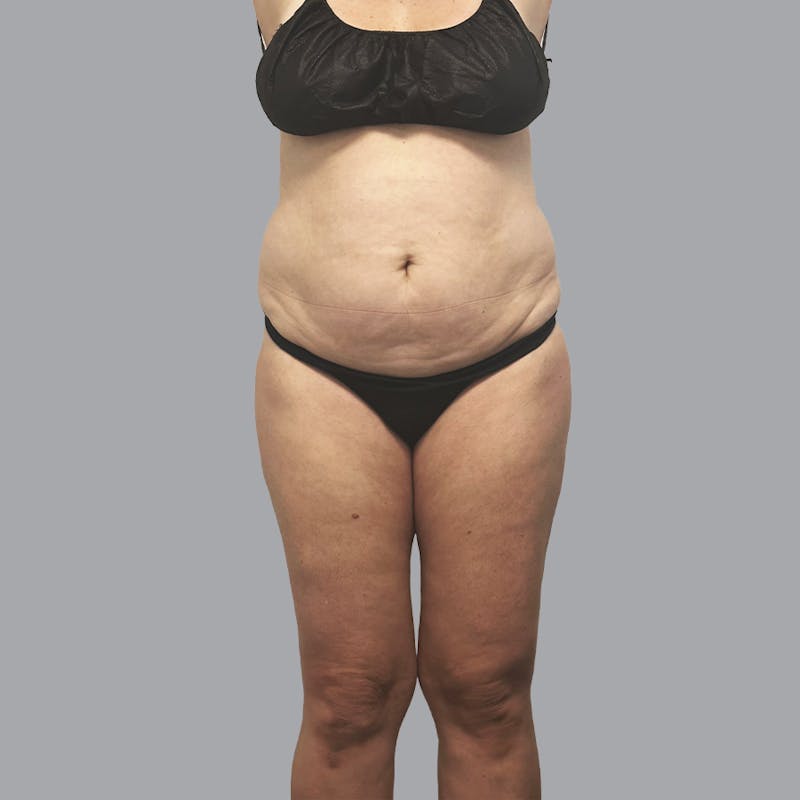 Body Liposuction Before & After Gallery - Patient 400657 - Image 1