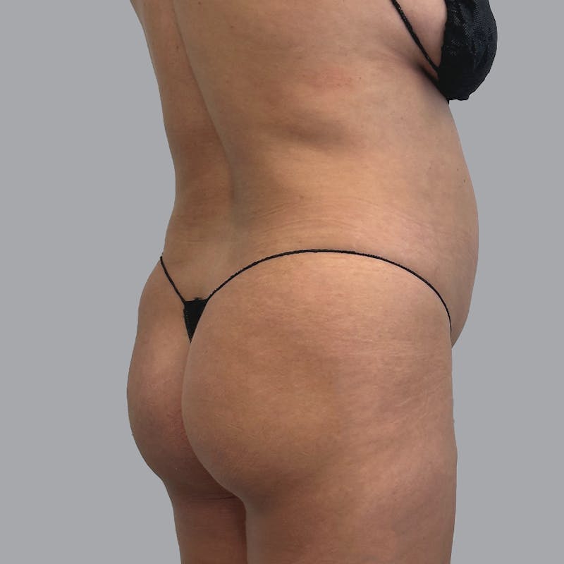 Body Liposuction Before & After Gallery - Patient 300193 - Image 5
