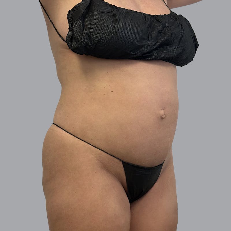 Body Liposuction Before & After Gallery - Patient 300193 - Image 1