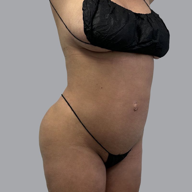Body Liposuction Before & After Gallery - Patient 300193 - Image 2