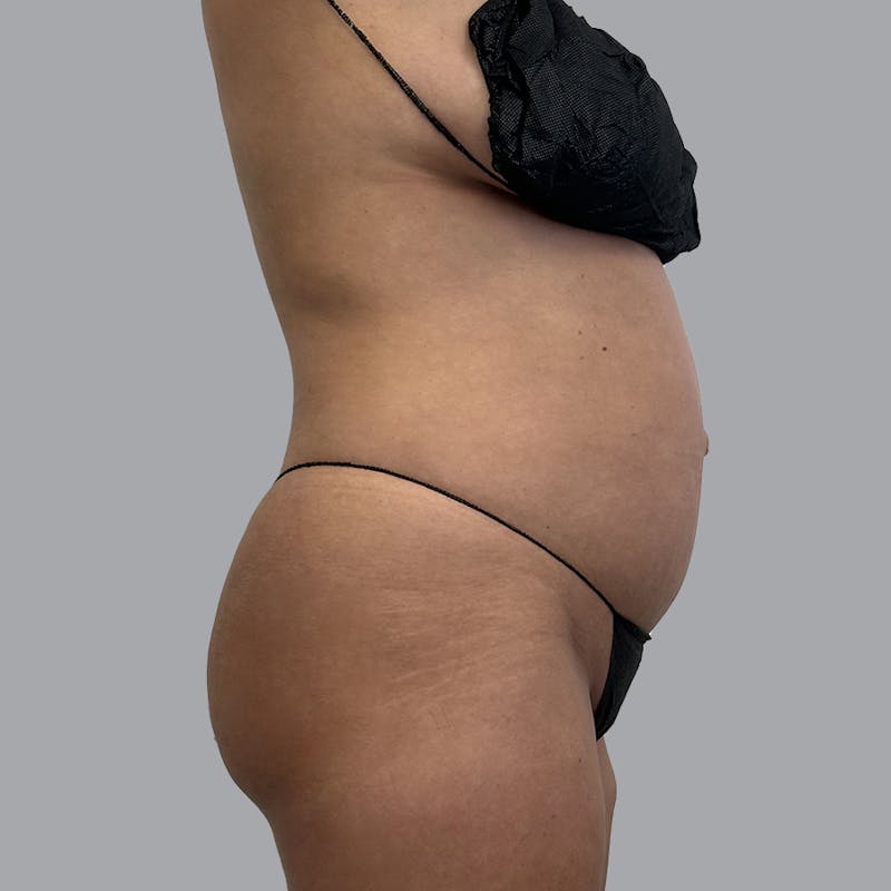 Body Liposuction Before & After Gallery - Patient 300193 - Image 3