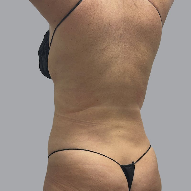 Body Liposuction Before & After Gallery - Patient 233091 - Image 6