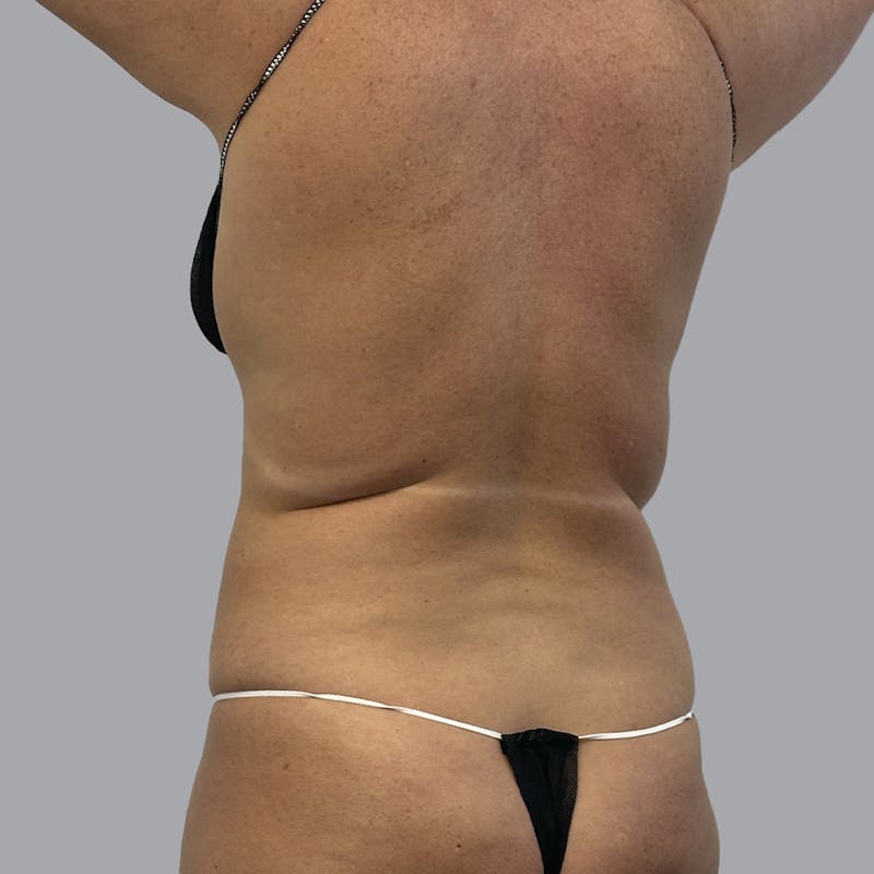 Body Liposuction Before & After Gallery - Patient 233091 - Image 5