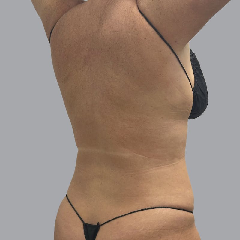 Body Liposuction Before & After Gallery - Patient 233091 - Image 4