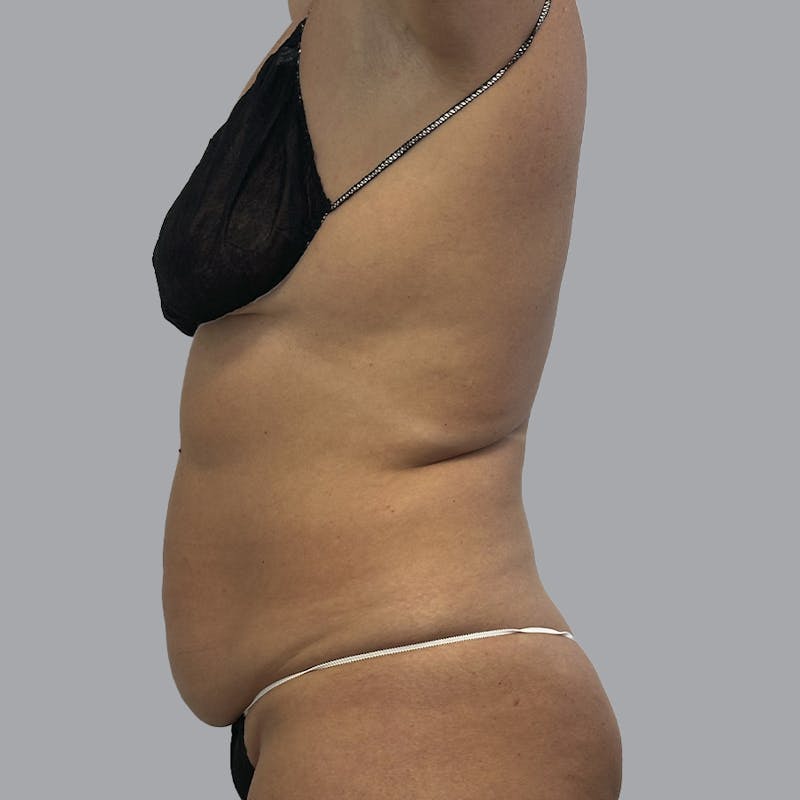 Body Liposuction Before & After Gallery - Patient 233091 - Image 7