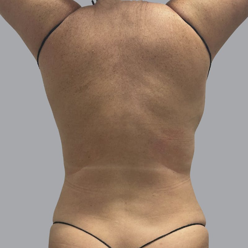 Body Liposuction Before & After Gallery - Patient 233091 - Image 2
