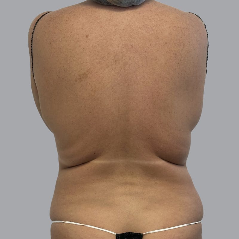 Body Liposuction Before & After Gallery - Patient 233091 - Image 1
