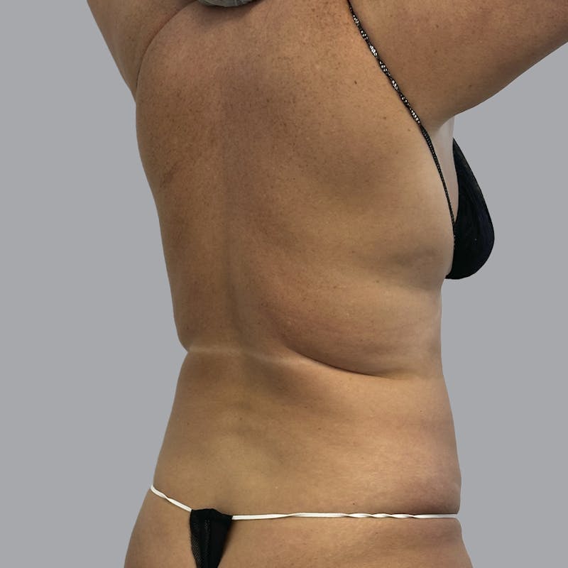 Body Liposuction Before & After Gallery - Patient 233091 - Image 3