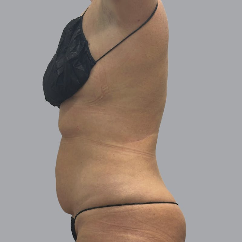 Body Liposuction Before & After Gallery - Patient 233091 - Image 8