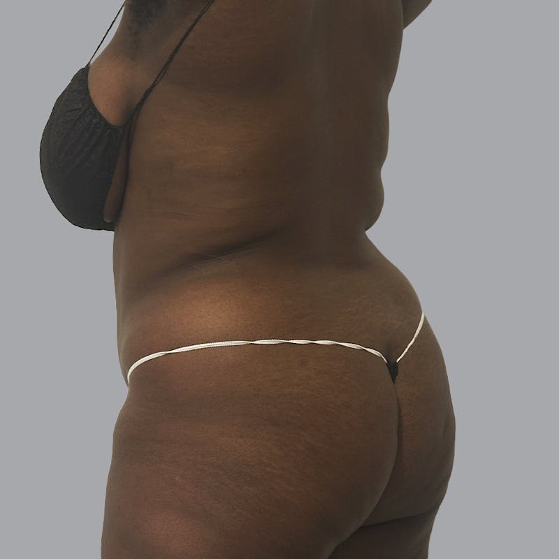Body Liposuction Before & After Gallery - Patient 335603 - Image 5