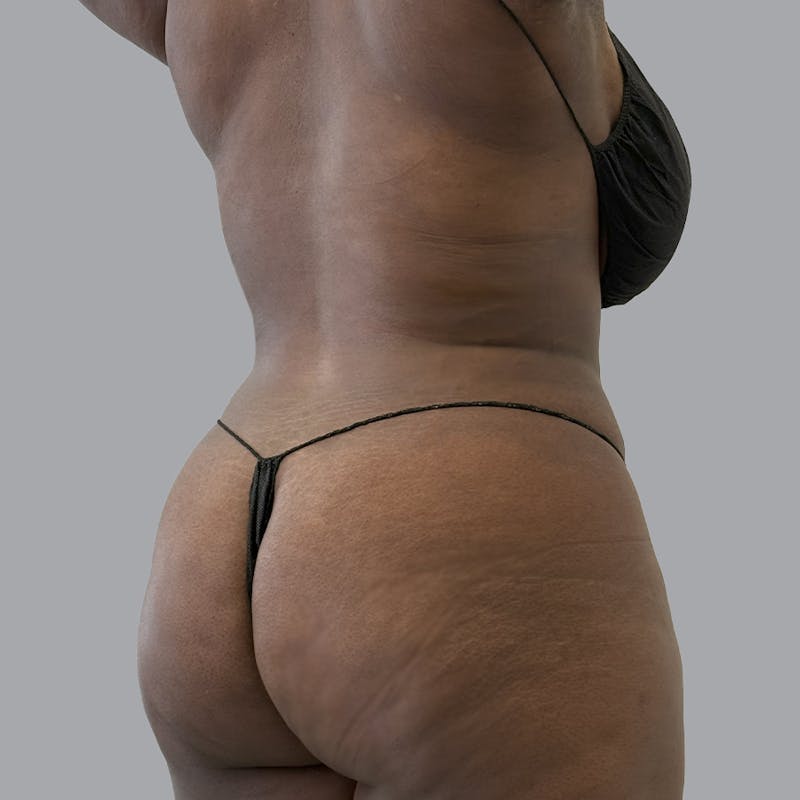 Body Liposuction Before & After Gallery - Patient 335603 - Image 2