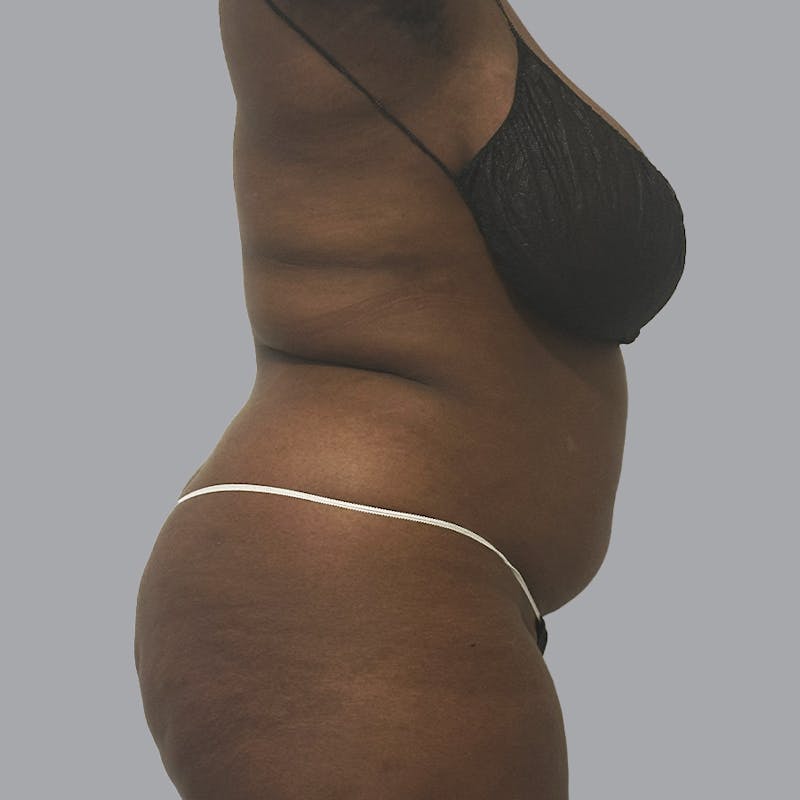 Body Liposuction Before & After Gallery - Patient 335603 - Image 3