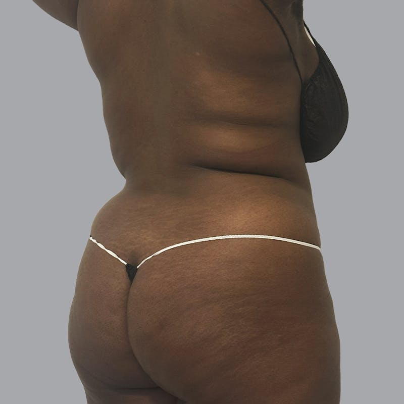 Body Liposuction Before & After Gallery - Patient 335603 - Image 1