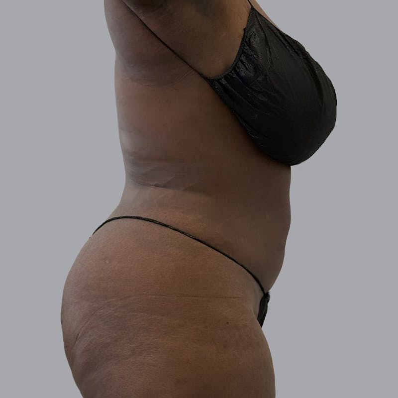 Body Liposuction Before & After Gallery - Patient 335603 - Image 4