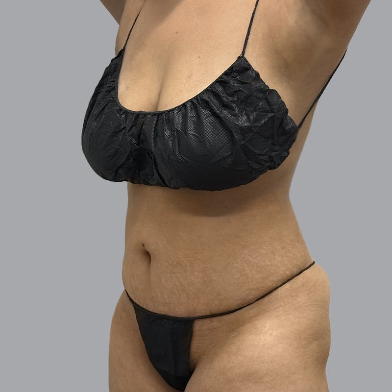 Abdominoplasty Before & After Gallery - Patient 372854 - Image 4