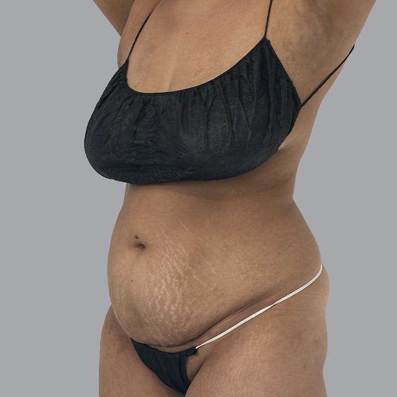 Abdominoplasty Before & After Gallery - Patient 372854 - Image 3