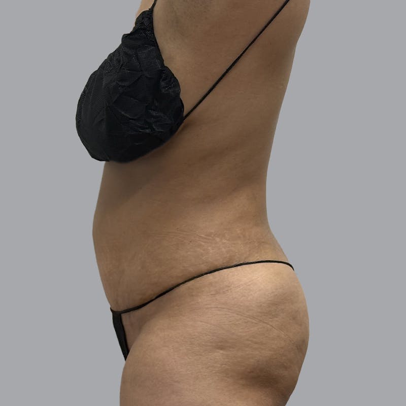 Abdominoplasty Before & After Gallery - Patient 372854 - Image 6