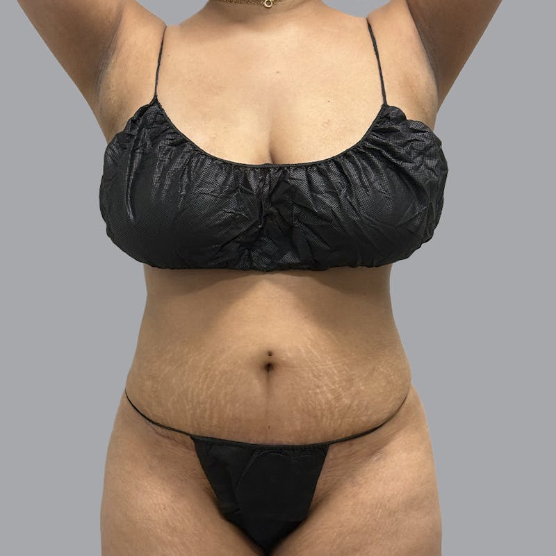 Abdominoplasty Before & After Gallery - Patient 372854 - Image 2