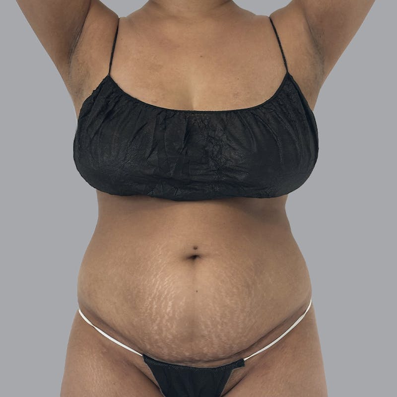 Abdominoplasty Before & After Gallery - Patient 372854 - Image 1