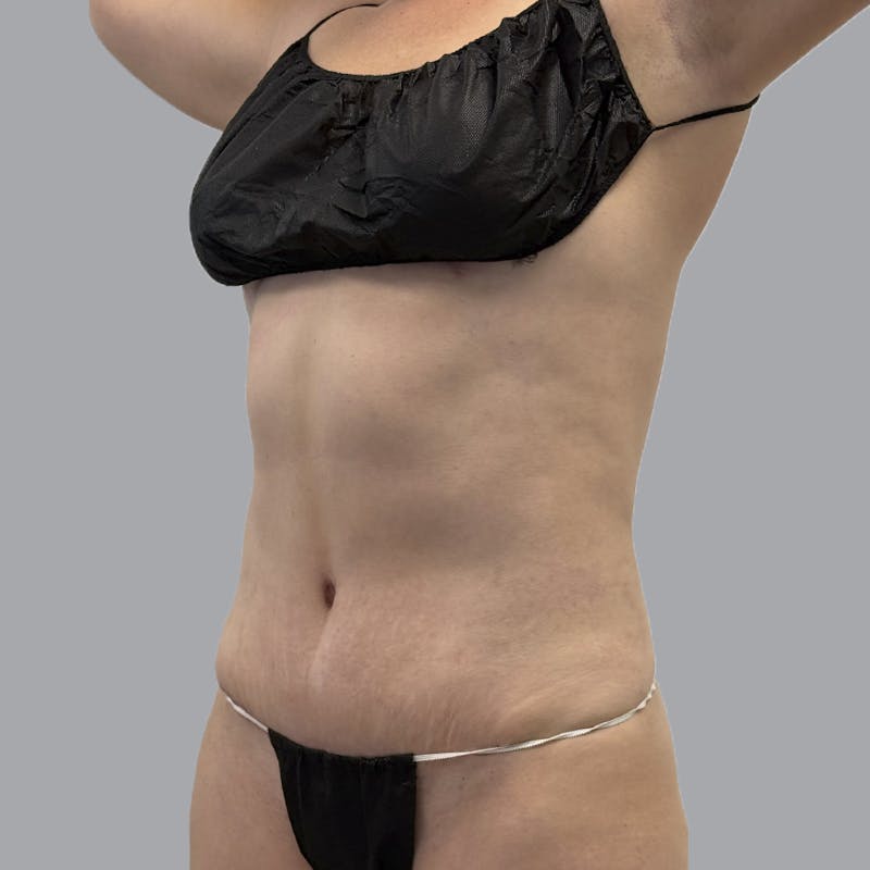 Abdominoplasty Before & After Gallery - Patient 975550 - Image 4