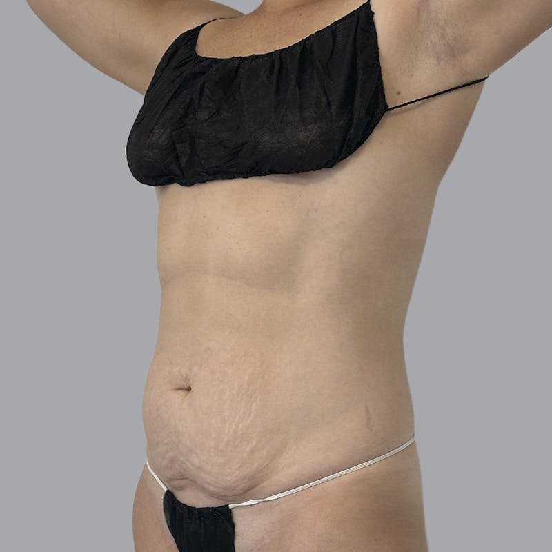 Abdominoplasty Before & After Gallery - Patient 975550 - Image 3