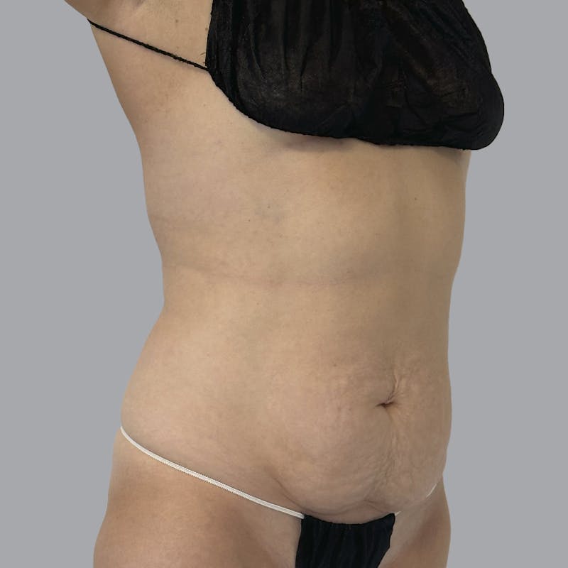 Abdominoplasty Before & After Gallery - Patient 975550 - Image 5