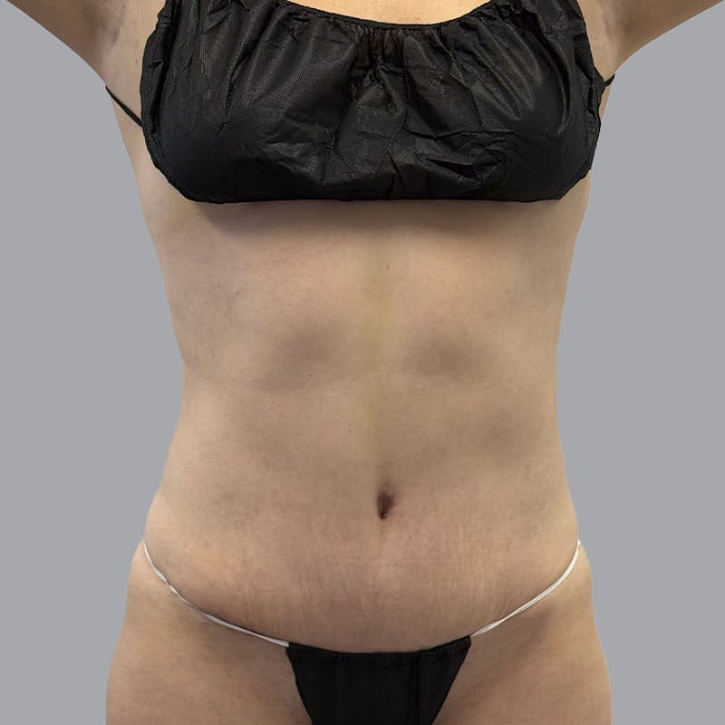 Abdominoplasty Before & After Gallery - Patient 975550 - Image 2