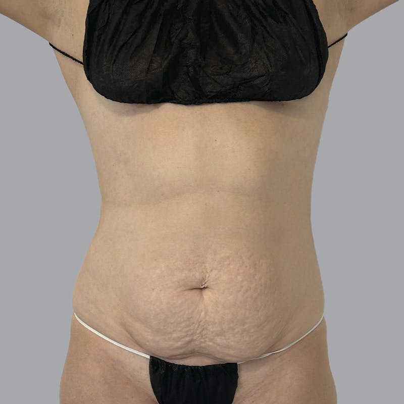 Abdominoplasty Before & After Gallery - Patient 975550 - Image 1