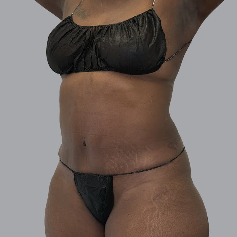 Abdominoplasty Before & After Gallery - Patient 168874 - Image 6