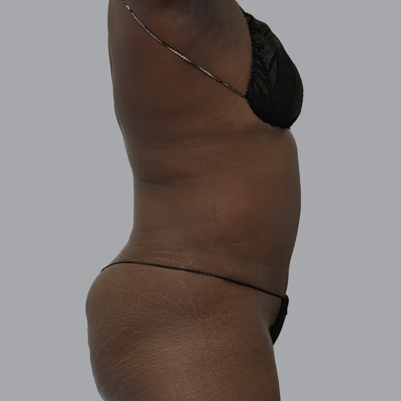Abdominoplasty Before & After Gallery - Patient 168874 - Image 4