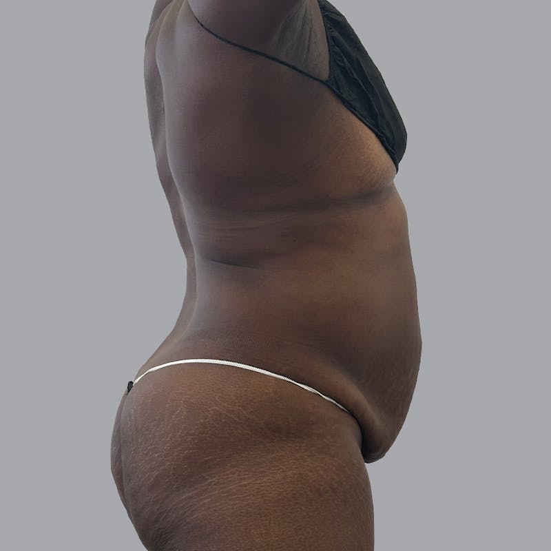 Abdominoplasty Before & After Gallery - Patient 168874 - Image 3