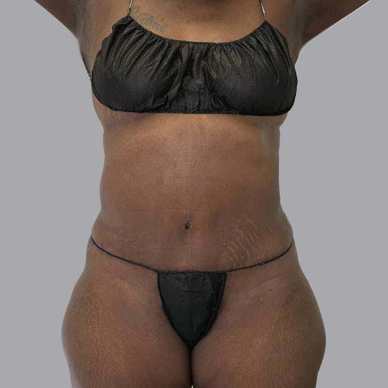 Abdominoplasty Before & After Gallery - Patient 168874 - Image 2