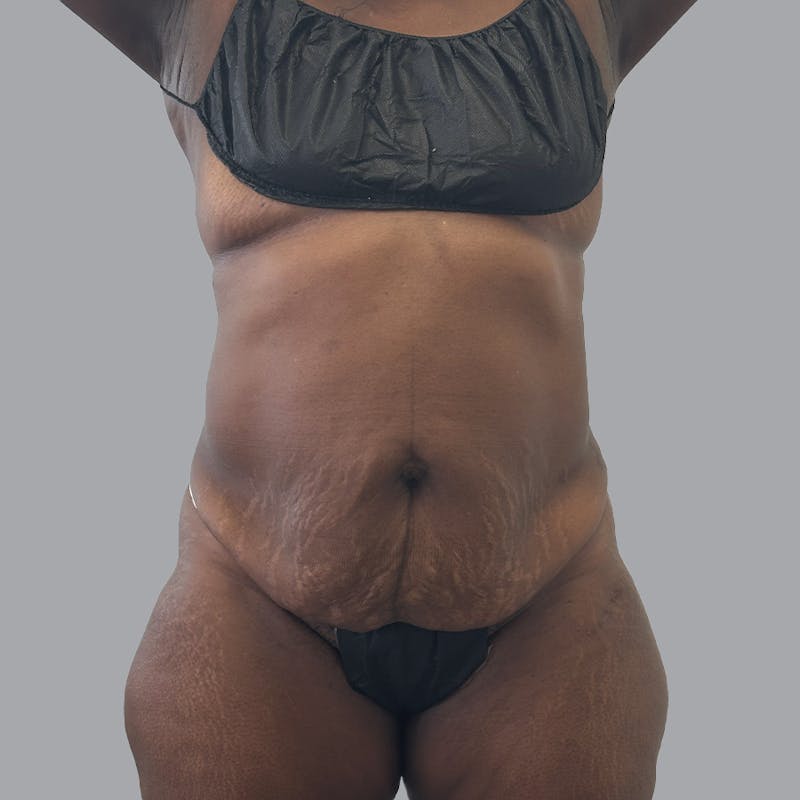 Abdominoplasty Before & After Gallery - Patient 168874 - Image 1