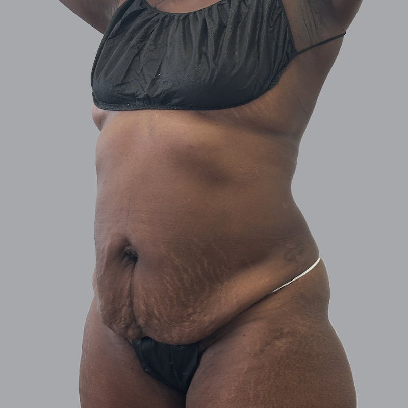 Abdominoplasty Before & After Gallery - Patient 168874 - Image 5
