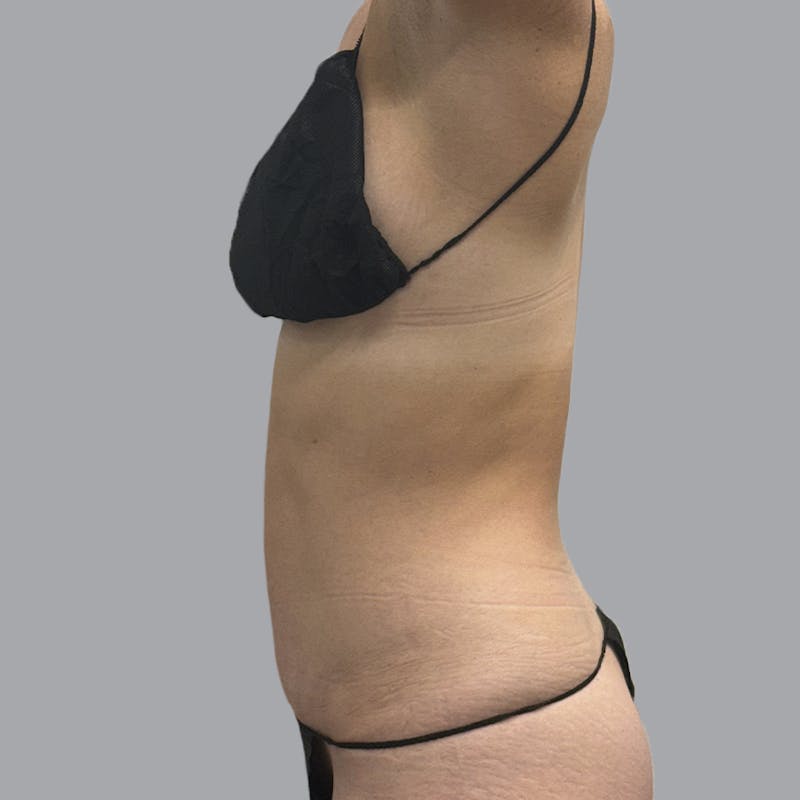 Abdominoplasty Before & After Gallery - Patient 192905 - Image 4
