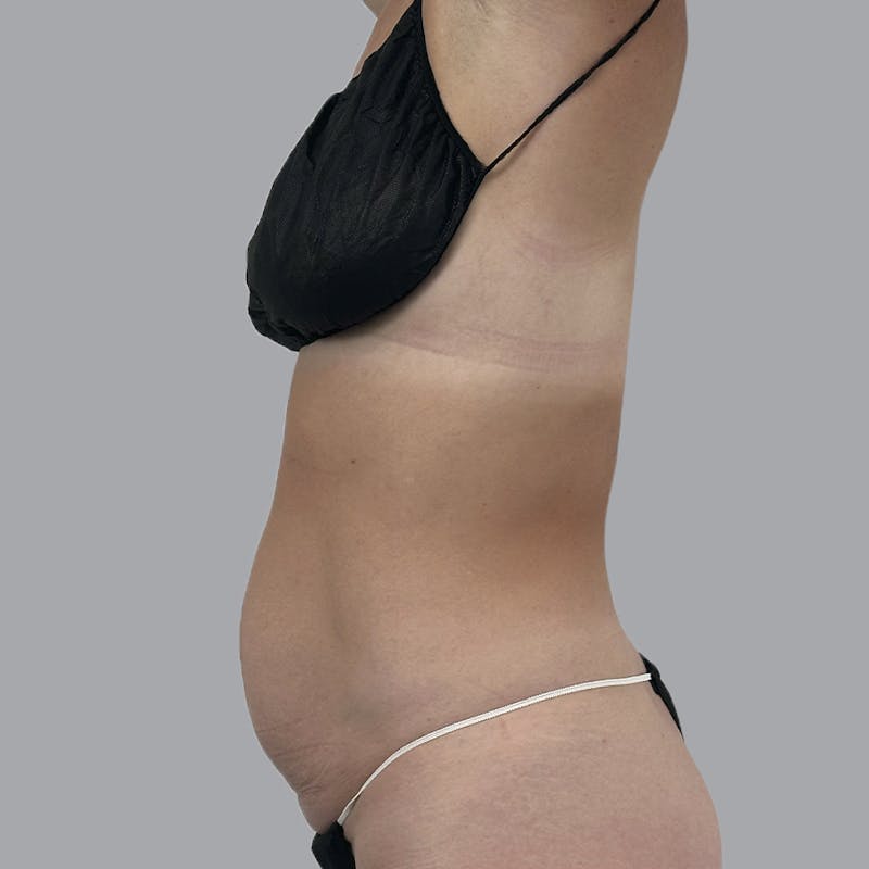 Abdominoplasty Before & After Gallery - Patient 192905 - Image 3