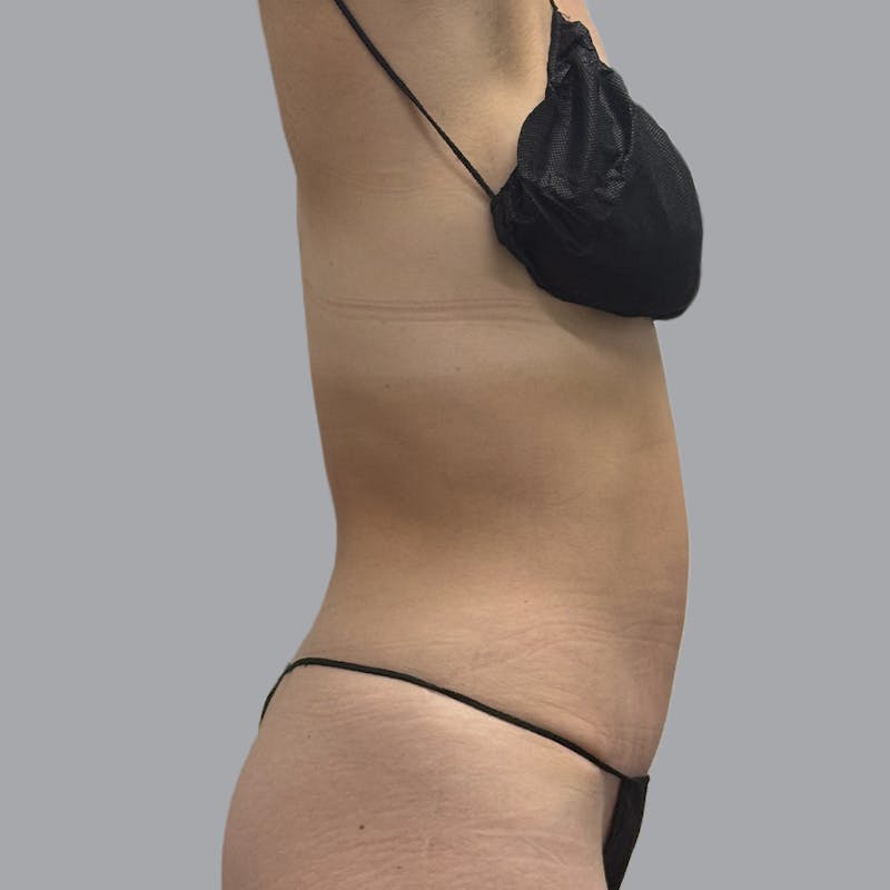 Abdominoplasty Before & After Gallery - Patient 192905 - Image 6
