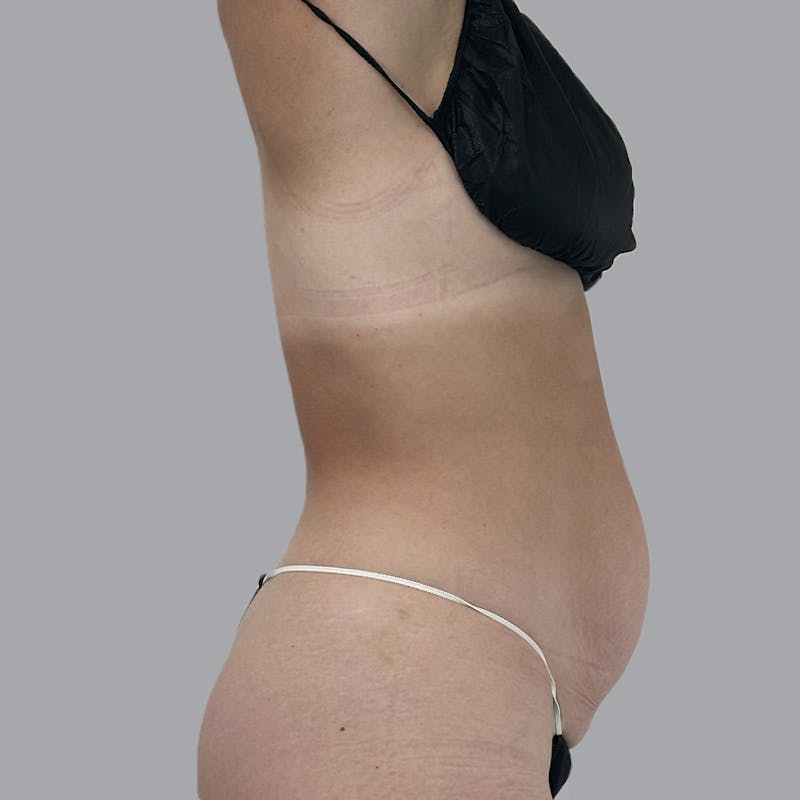 Abdominoplasty Before & After Gallery - Patient 192905 - Image 5