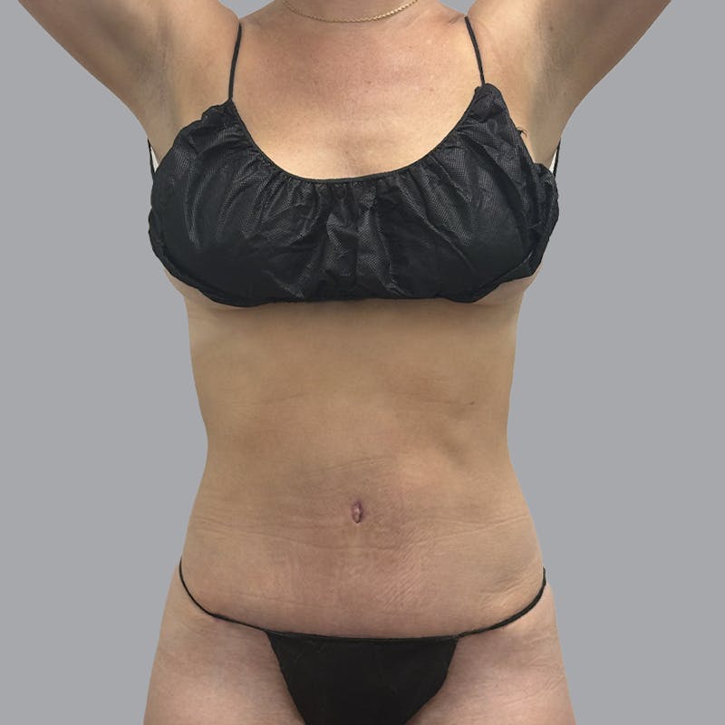 Abdominoplasty Before & After Gallery - Patient 192905 - Image 2