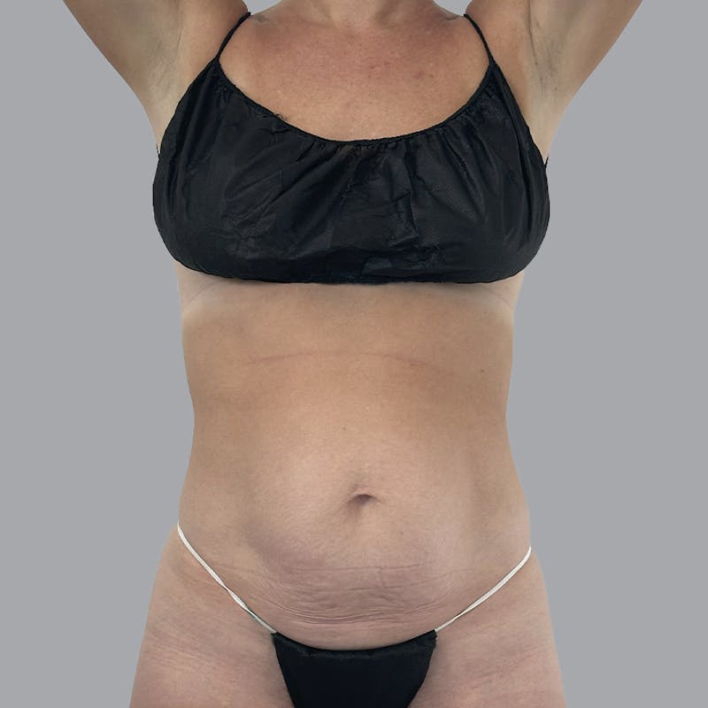 Abdominoplasty Before & After Gallery - Patient 192905 - Image 1