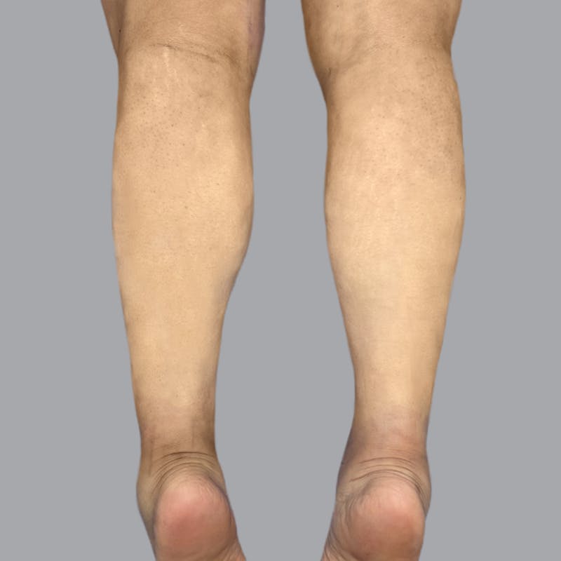 Leg Liposuction Before & After Gallery - Patient 361124 - Image 4